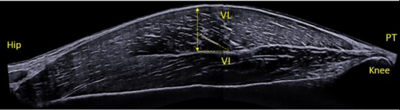 composition of the quadriceps muscles 